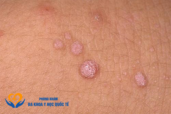 Nổi mụn thịt ở vùng kín
