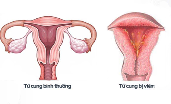 Viêm nội mạc tử cung là một trong những biến chứng có thể xảy ra khi phá thai 16 tuần