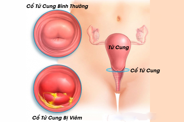Viêm cổ tử cung là bệnh lí gắn liền với tình trạng ngứa vùng kín kèm khí hư