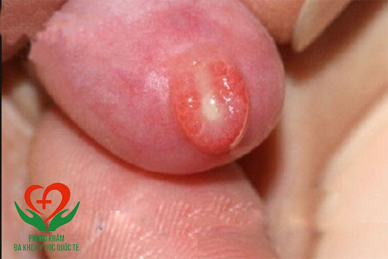 Viêm bao quy đầu có mủ ở trẻ nhỏ