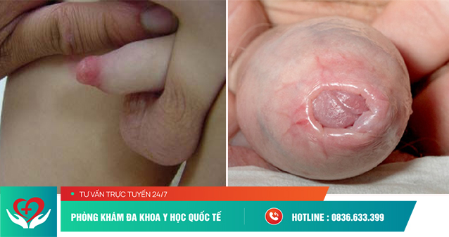 Viêm bao quy đầu là điều kiện phát triển các bệnh viêm nhiễm khác ảnh hưởng tới khả năng sinh sản sau này của trẻ
