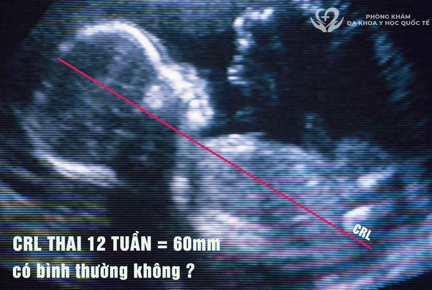 Chiều dài thai 12 tuần 60mm có bình thường không