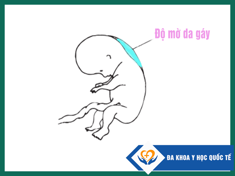 Độ mờ da gáy là chỉ số cần thiết để xác định di tật thai nhi