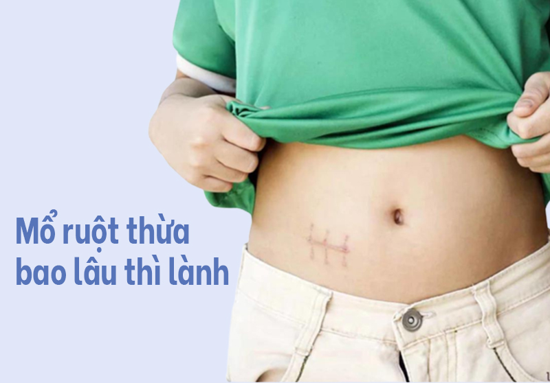 Mổ ruột thừa bao lâu thì lành