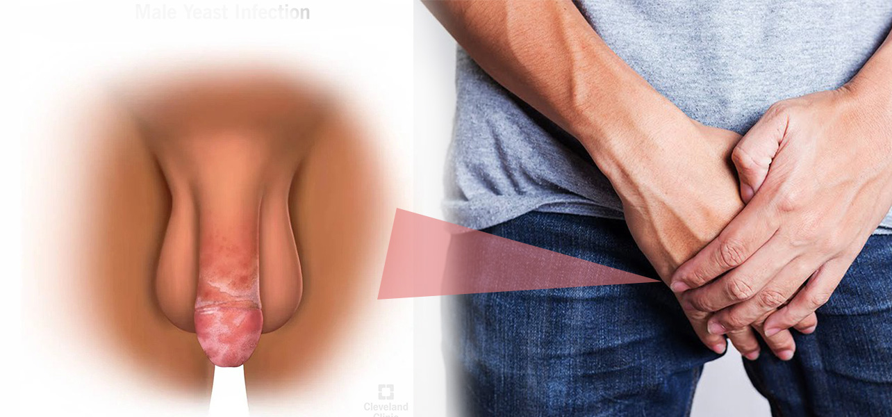 Bao quy đầu nổi mẩn đỏ và ngứa là bệnh gì