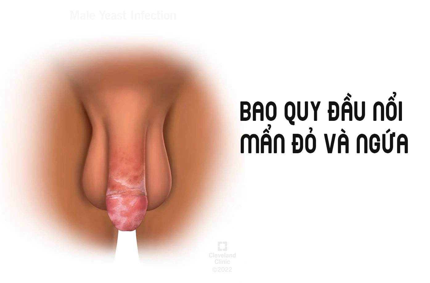 Bao quy đầu nổi mẩn đỏ và ngứa có nguy hiểm không 