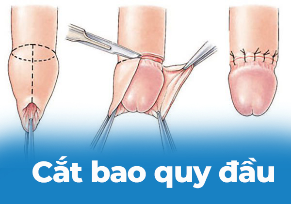 Cắt bao quy đầu