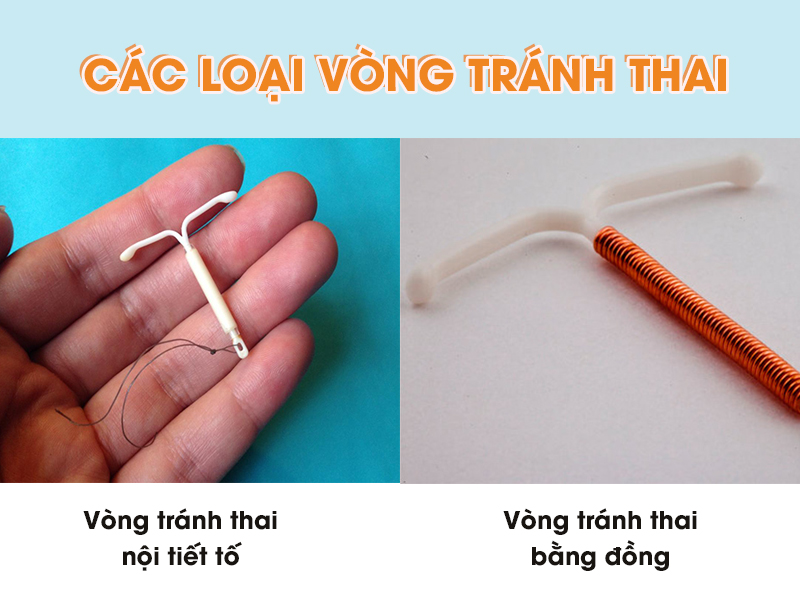Các loại vòng tránh thai phổ biến