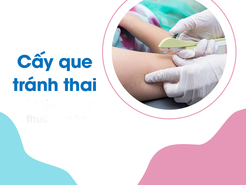 Cấy que tránh thai