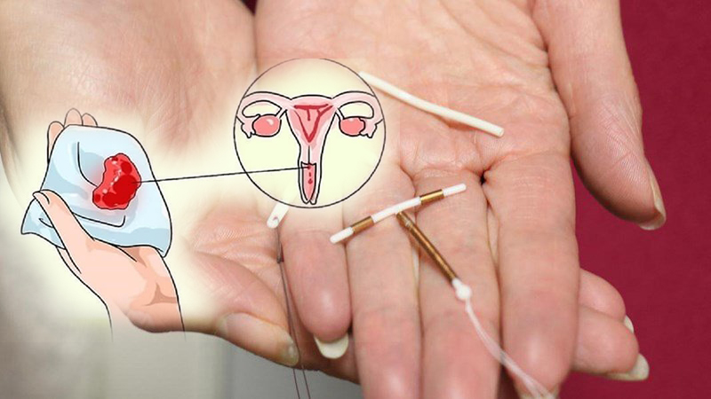 Tác dụng phụ khi đặt vòng tránh thai