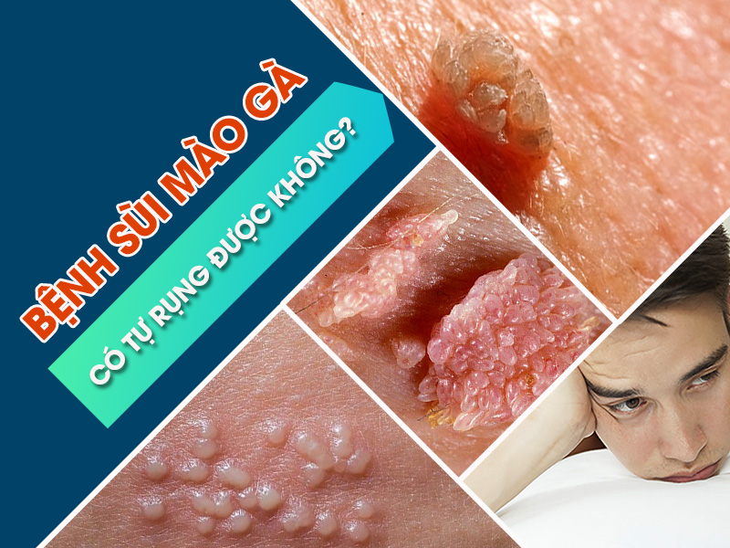 Sùi mào gà có tự rụng không?