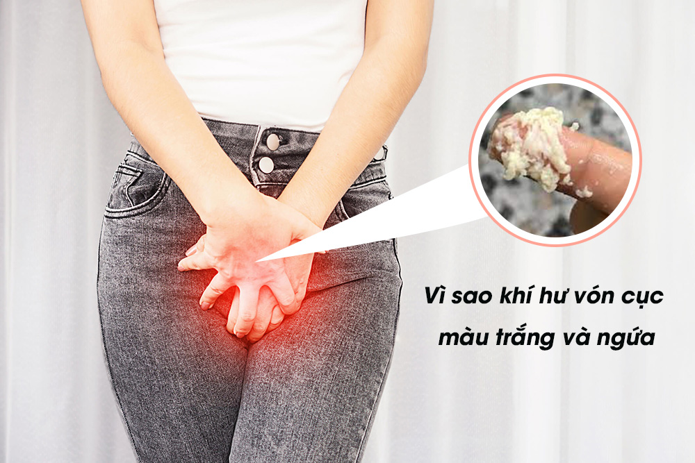Vì sao khí hư vón cục màu trắng và ngứa