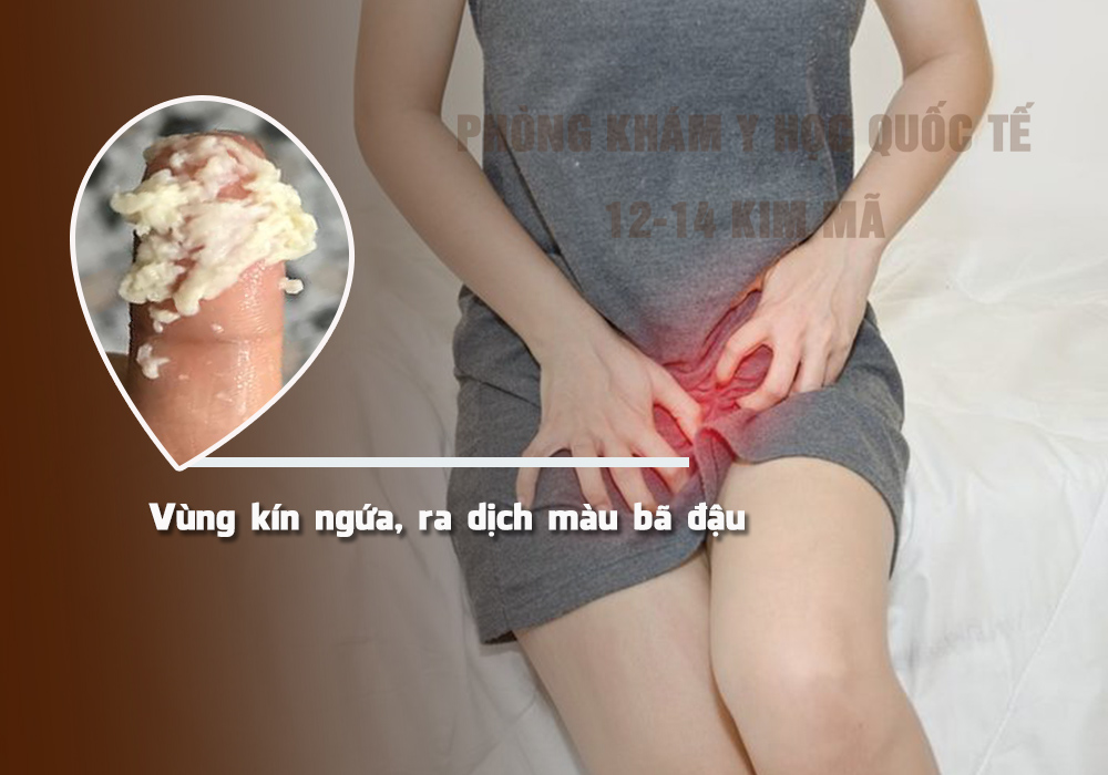 Vùng kín bị ngứa ra dịch bã đậu là bệnh gì