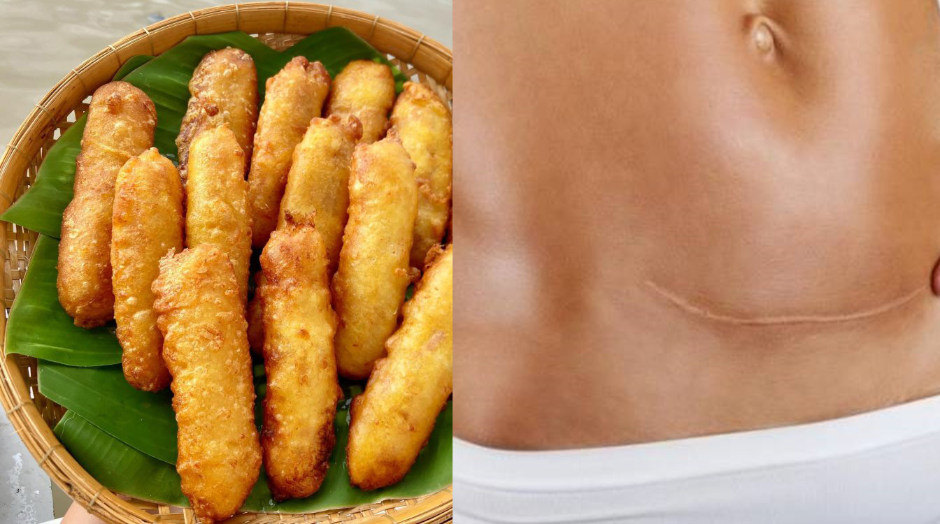 Sinh mổ ăn bánh chuối chiên được không