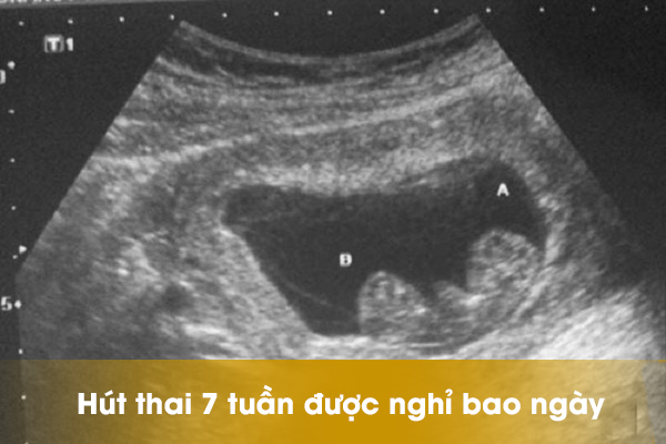Hút thai 7 tuần được nghỉ bao ngày