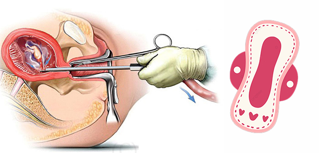 Thời gian ra máu bình thường sau hút thai