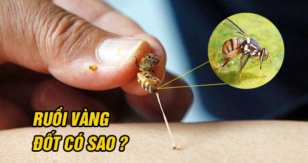 Bị ruồi vàng đốt có sao không ?