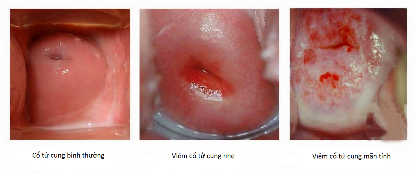 Viêm cổ tử cung