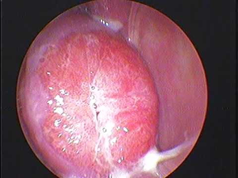 Cổ tử cung qua hình ảnh nội soi